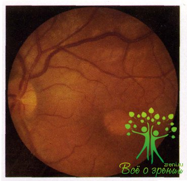 Атлас глазных болезней | Врожденная и врожденно-наследственная патология органа зрения (Чать 2)