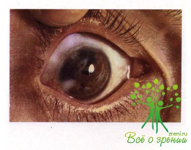 Атлас глазных болезней | Механические травмы органа зрения (Часть 2)