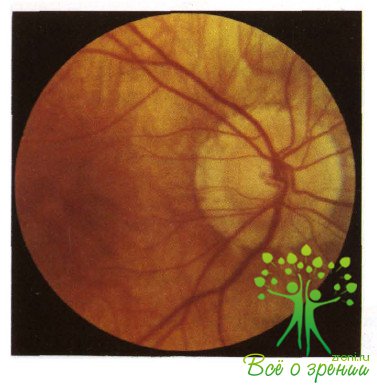 Атлас глазных болезней | Изменения глазного дна при близорукости (Миопии)