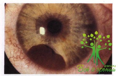 Атлас глазных болезней | Внутриглазные новообразования