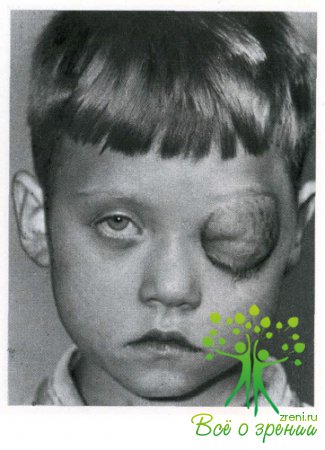 Генетические синдромы с нарушением зрения thumbnail