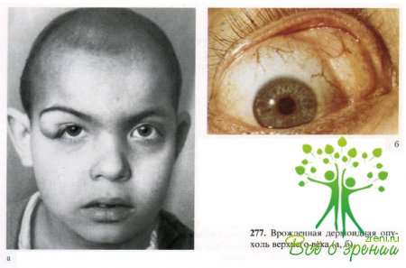 Генетические синдромы с нарушением зрения