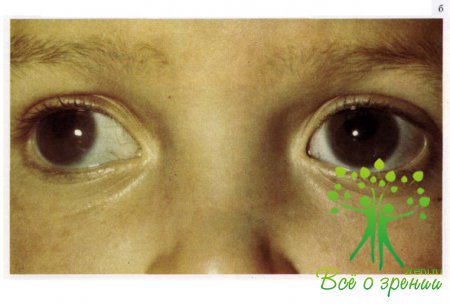 Генетические синдромы с нарушением зрения