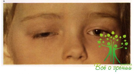 Пороки развития глаз у ребенка