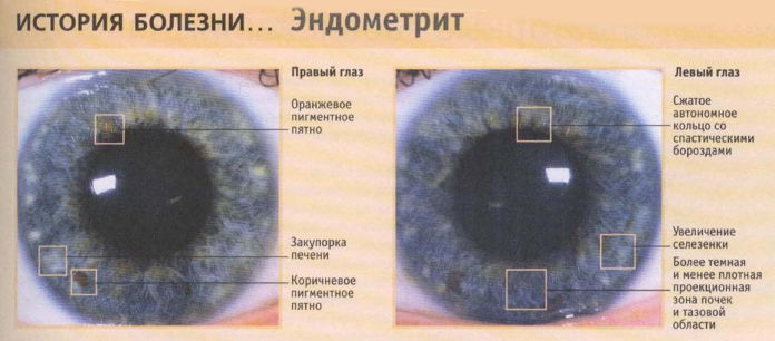Как узнать какой болезнь. Иридодиагностика радужной оболочки глаза. Иридодиагностика болезни по глазам. Диагностика по радужке глаза. Диагноз по радужной оболочке глаза.