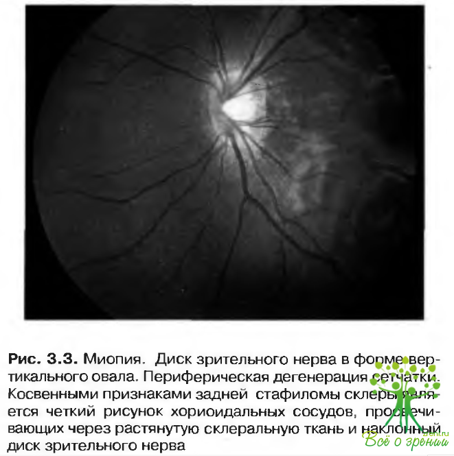 Расширение пространства зрительного нерва. Глаукоматозная атрофия зрительного нерва. Перипапиллярная атрофия зрительного нерва. Наклонные диски зрительного нерва. Миелинизация зрительного нерва.