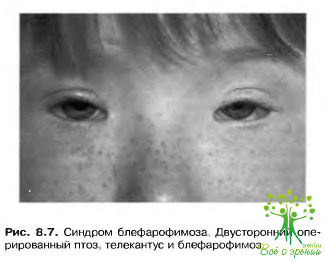 Врожденный птоз. Пальпебральный синдром блефарофимоз птоз. Врожденный блефарофимоз. Генетическое заболевание блефарофимоз.