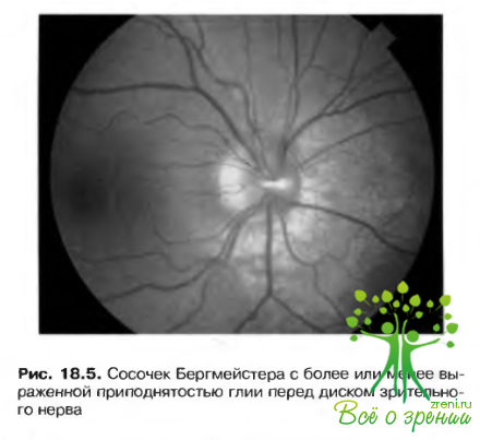 Заболевания переднего отдела зрительного пути (Часть 1) | Детская офтальмология