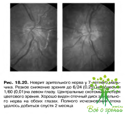 Заболевания переднего отдела зрительного пути (Часть 2) | Детская офтальмология