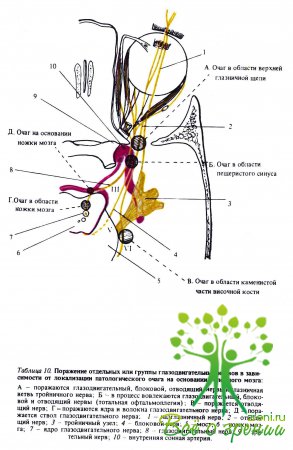 Поражение отдельных или группы глазодвигательных нервов в зависимости от локализации патологического очага на основании головного мозга