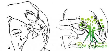 Рис. 3. Вставление глазного протеза (а); вынимание глазного протеза (б)