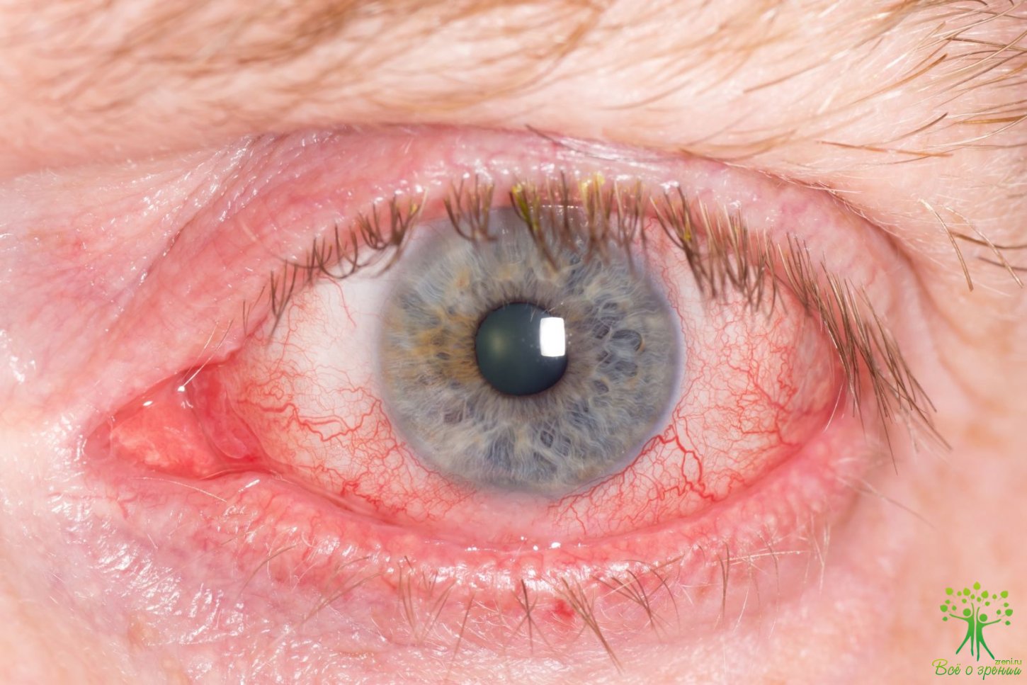 Синдром «красного глаза» без снижения зрительных функций
