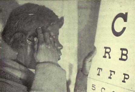 Рисунок 33. Пациент с атрофией зрительного нерва наблюдает проблески улучшенного зрения после пальминга.